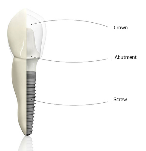 teeth implant construction