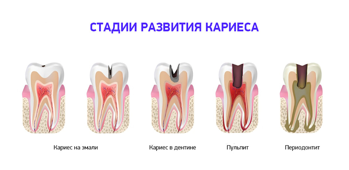 Кариес зубов