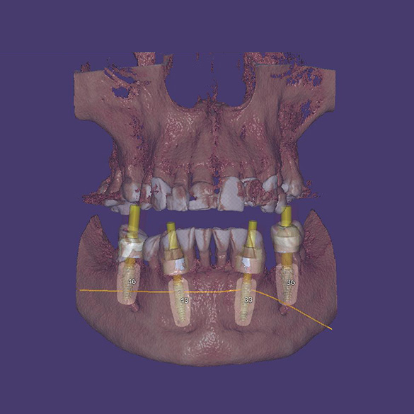Tomography of the position of dental implants in the bone