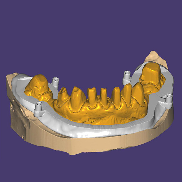 Определение уровня среза кости и количество удаляемых зубов (выделено желтым цветом)