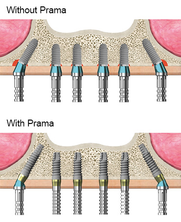 implants prama